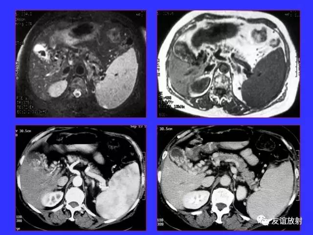 肝实质异常灌注CT、MRI评价