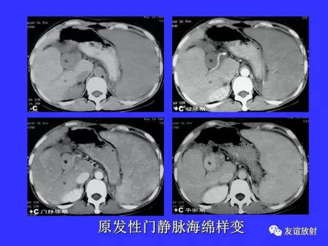 肝实质异常灌注CT、MRI评价
