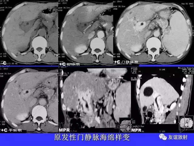 肝实质异常灌注CT、MRI评价