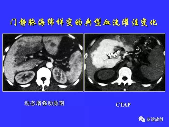肝实质异常灌注CT、MRI评价