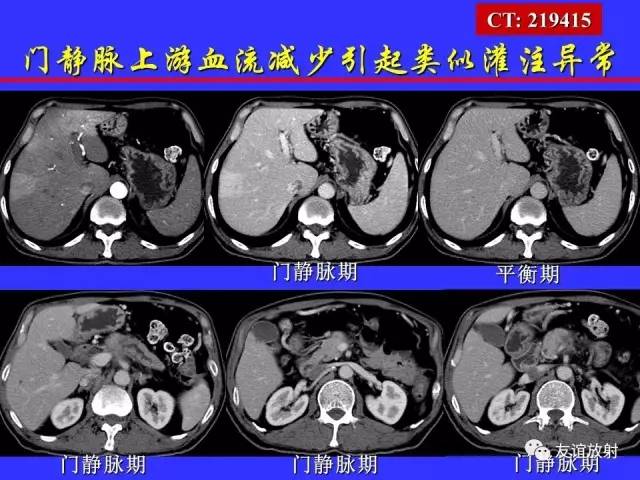 肝实质异常灌注CT、MRI评价