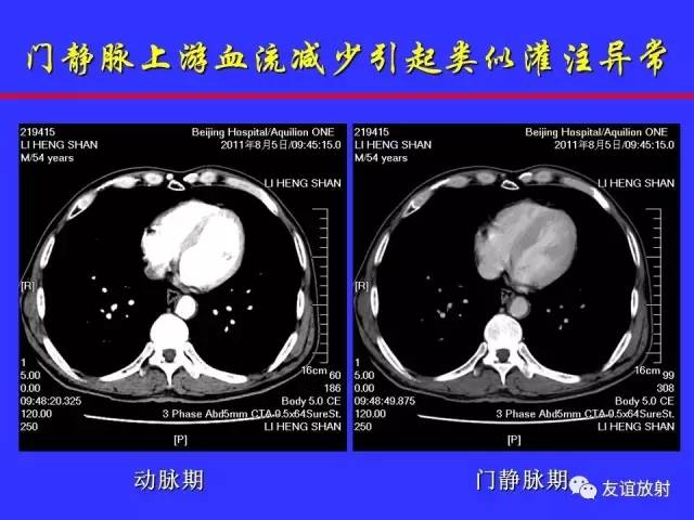 肝实质异常灌注CT、MRI评价