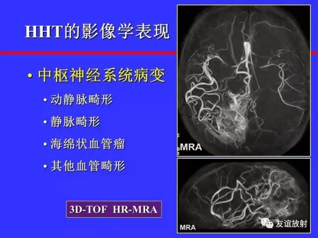 肝实质异常灌注CT、MRI评价