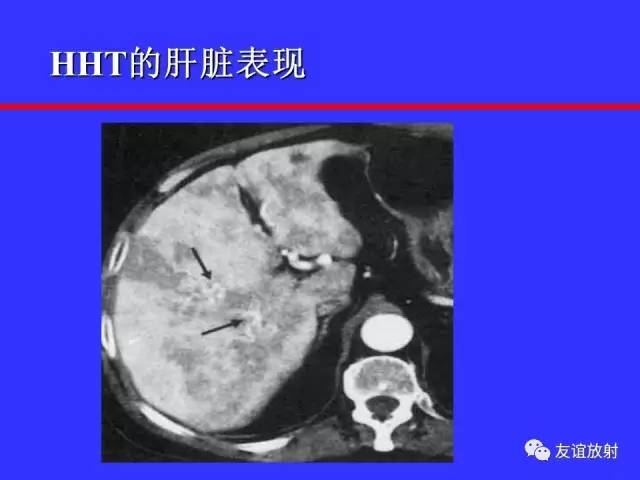 肝实质异常灌注CT、MRI评价