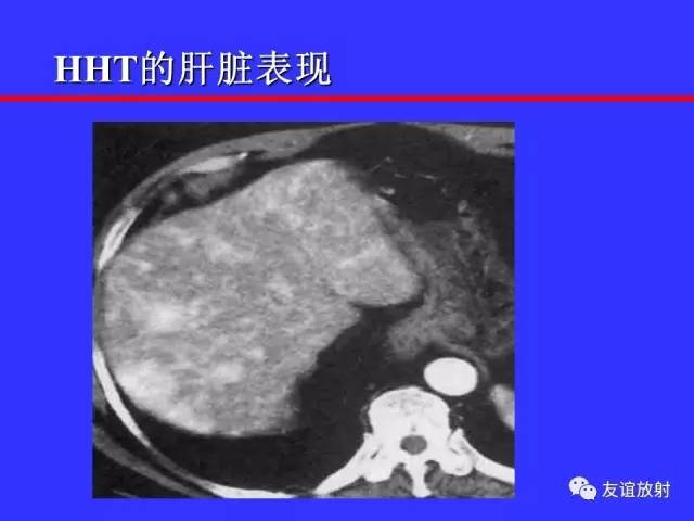 肝实质异常灌注CT、MRI评价
