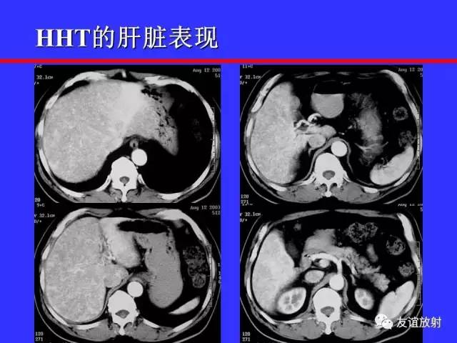 肝实质异常灌注CT、MRI评价