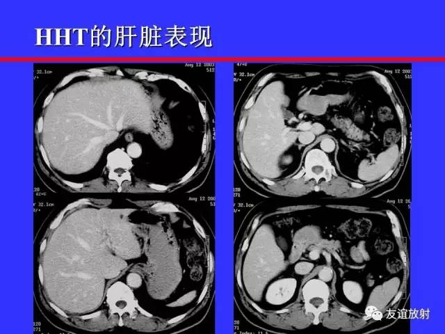 肝实质异常灌注CT、MRI评价
