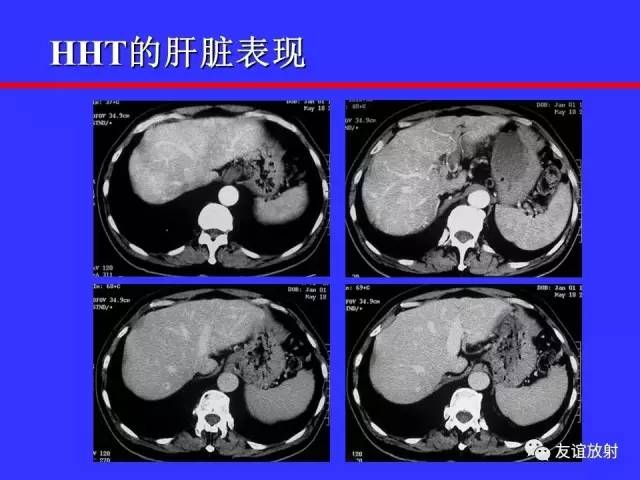 肝实质异常灌注CT、MRI评价