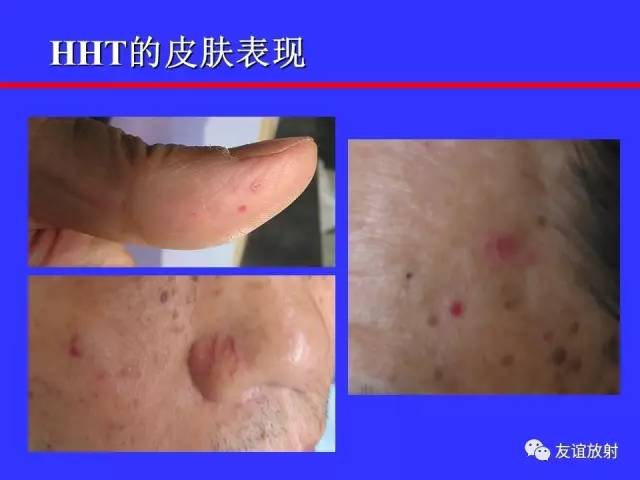 肝实质异常灌注CT、MRI评价