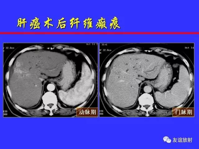 肝实质异常灌注CT、MRI评价