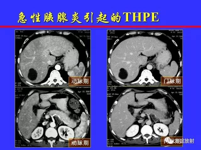 肝实质异常灌注CT、MRI评价