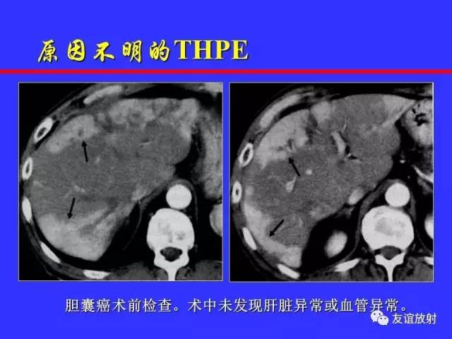 肝实质异常灌注CT、MRI评价