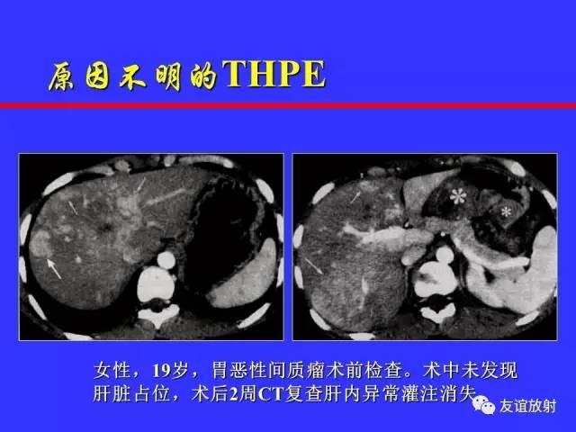 肝实质异常灌注CT、MRI评价