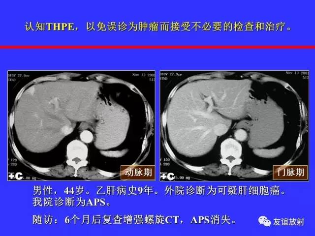 肝实质异常灌注CT、MRI评价