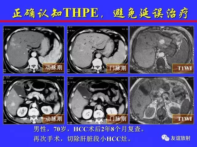 肝实质异常灌注CT、MRI评价