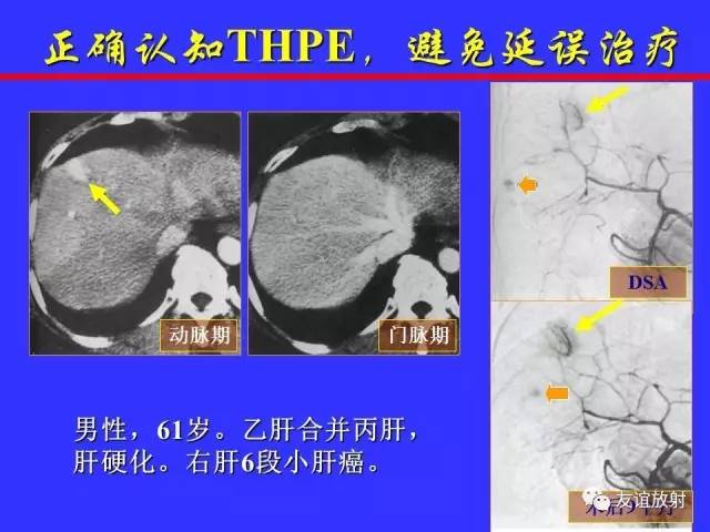 肝实质异常灌注CT、MRI评价