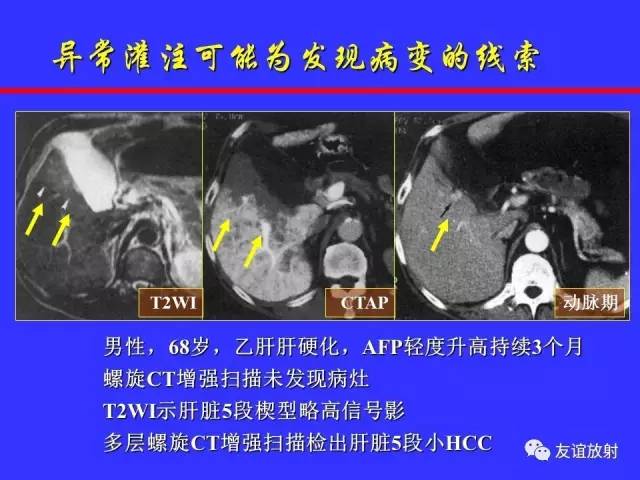 肝实质异常灌注CT、MRI评价