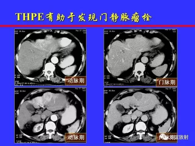 肝实质异常灌注CT、MRI评价