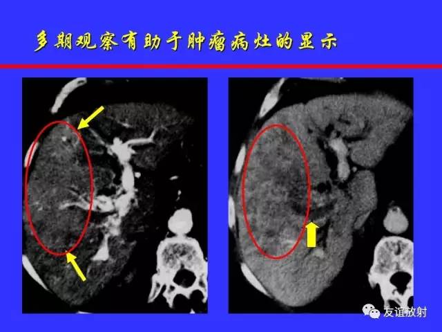 肝实质异常灌注CT、MRI评价