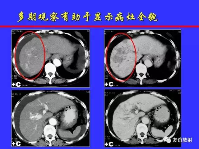 肝实质异常灌注CT、MRI评价