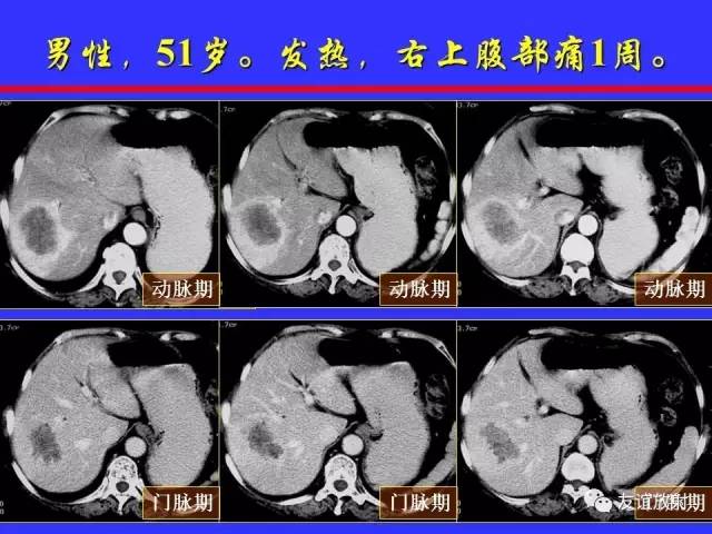肝实质异常灌注CT、MRI评价