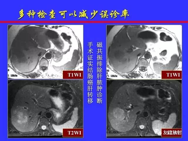 肝实质异常灌注CT、MRI评价