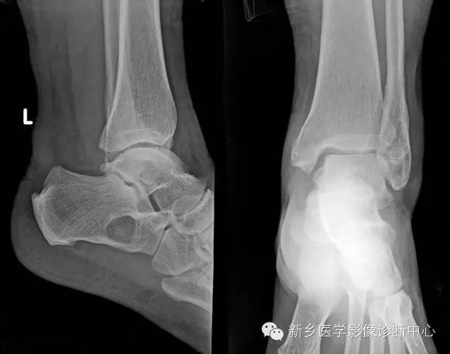 发生的跟骨的6种常见病变