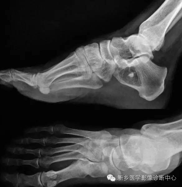 发生的跟骨的6种常见病变 发生的跟骨的6种常见病变