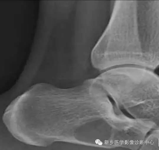 发生的跟骨的6种常见病变 发生的跟骨的6种常见病变