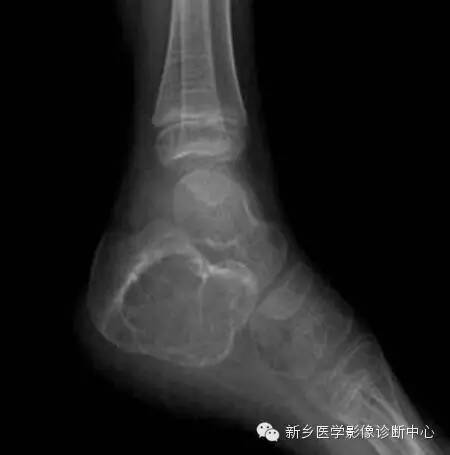 发生的跟骨的6种常见病变 发生的跟骨的6种常见病变