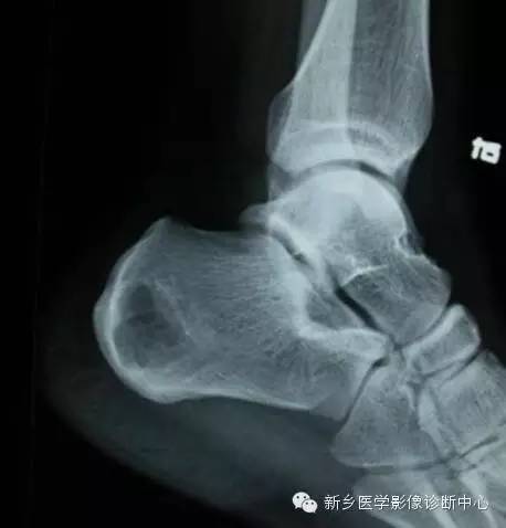 发生的跟骨的6种常见病变 发生的跟骨的6种常见病变