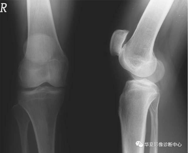 【PPT】髌骨高位