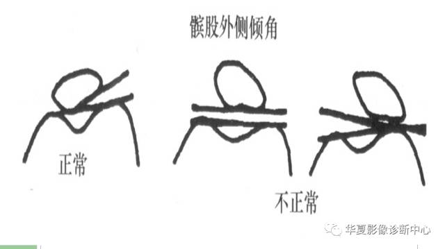 【PPT】髌骨高位