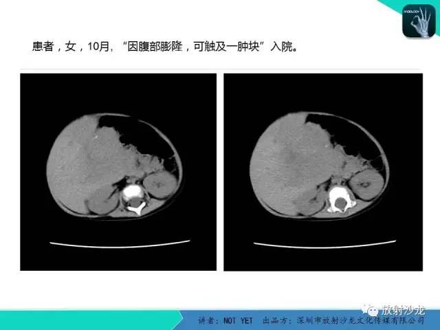 【病例】肝母细胞瘤1例CT影像表现