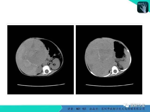 【病例】肝母细胞瘤1例CT影像表现