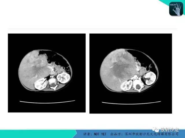 【病例】肝母细胞瘤1例CT影像表现