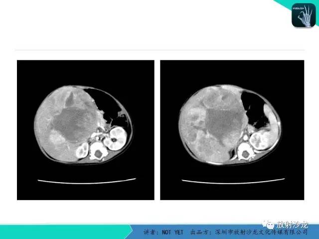 【病例】肝母细胞瘤1例CT影像表现
