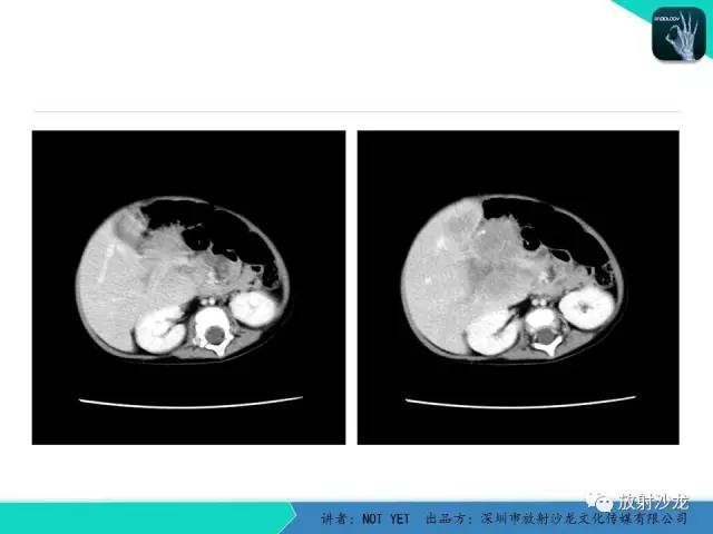 【病例】肝母细胞瘤1例CT影像表现