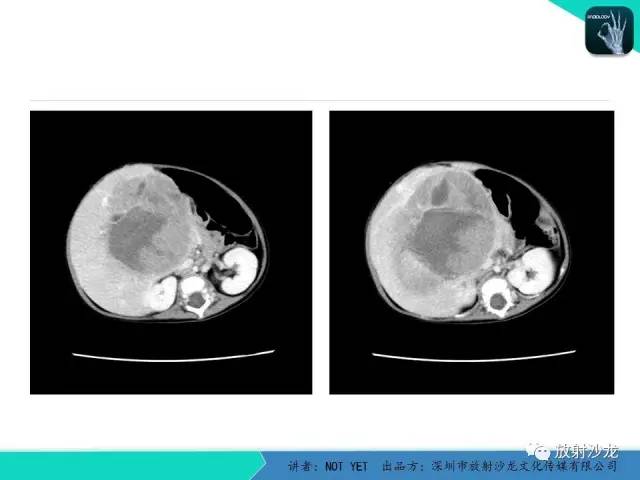 【病例】肝母细胞瘤1例CT影像表现