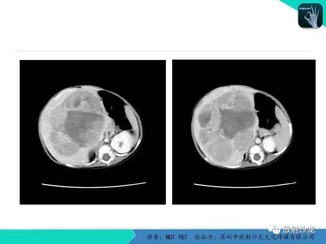 【病例】肝母细胞瘤1例CT影像表现