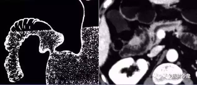 6种胰腺先天性病变