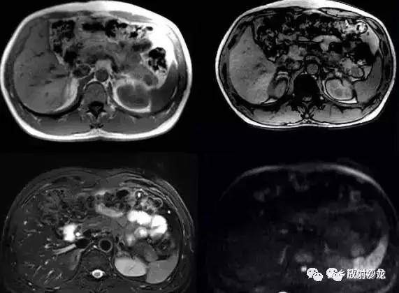 6种胰腺先天性病变