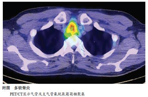 【病例】气道复发性多软骨炎1例PET/CT