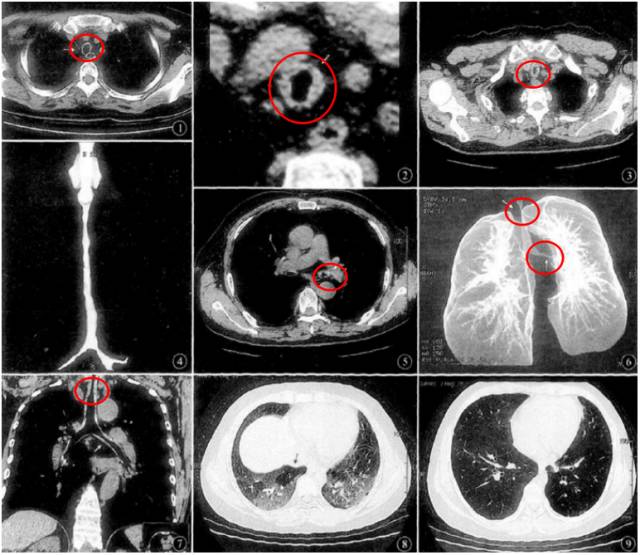 【病例】气道复发性多软骨炎1例PET/CT 【病例】气道复发性多软骨炎1例PET/CT