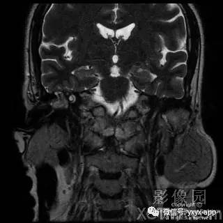 【病例】外耳道鳞癌1例MRI影像诊断分析 【病例】外耳道鳞癌1例MRI影像诊断分析