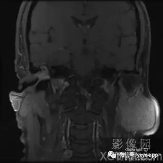 【病例】外耳道鳞癌1例MRI影像诊断分析 【病例】外耳道鳞癌1例MRI影像诊断分析