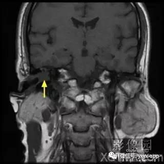 【病例】外耳道鳞癌1例MRI影像诊断分析 【病例】外耳道鳞癌1例MRI影像诊断分析