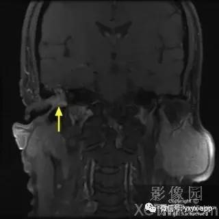 【病例】外耳道鳞癌1例MRI影像诊断分析 【病例】外耳道鳞癌1例MRI影像诊断分析