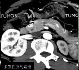 【病例】多发性内分泌肿瘤综合征1例 【病例】多发性内分泌肿瘤综合征1例
