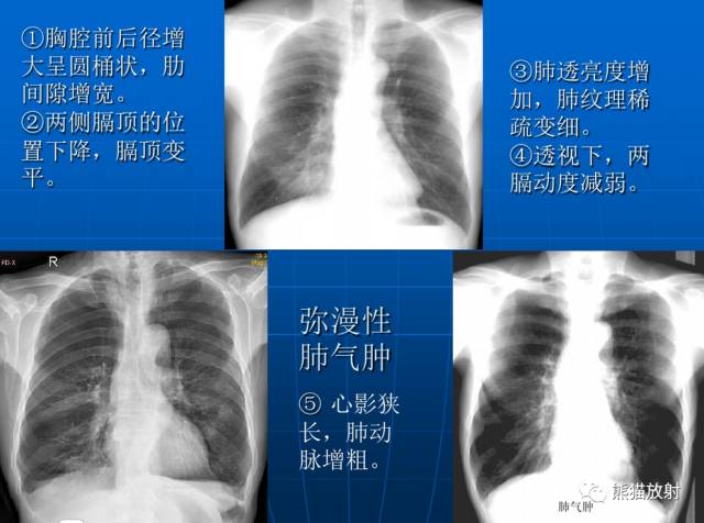 肺气肿的“千姿百态”! 肺气肿的“千姿百态”!